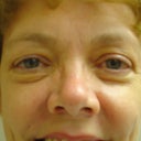 Eye area before treatment